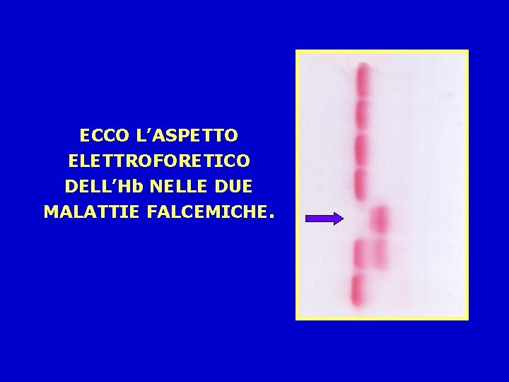 ECCO L’ASPETTO ELETTROFORETICO DELL’Hb NELLE DUE MALATTIE FALCEMICHE. 