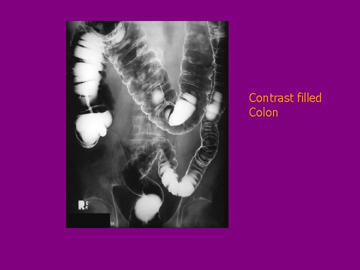 Contrast filled Colon 