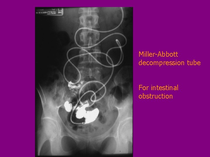 Miller-Abbott decompression tube For intestinal obstruction 
