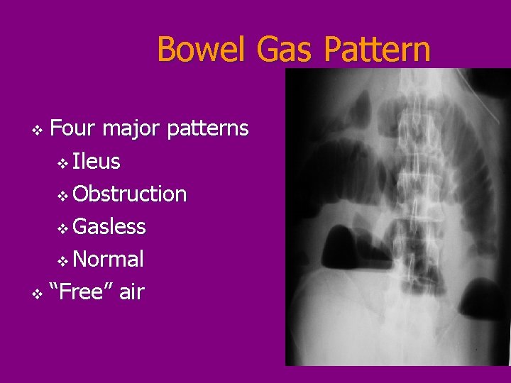 Bowel Gas Pattern Four major patterns v Ileus v Obstruction v Gasless v Normal