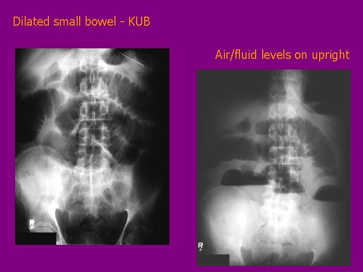 Dilated small bowel - KUB Air/fluid levels on upright 
