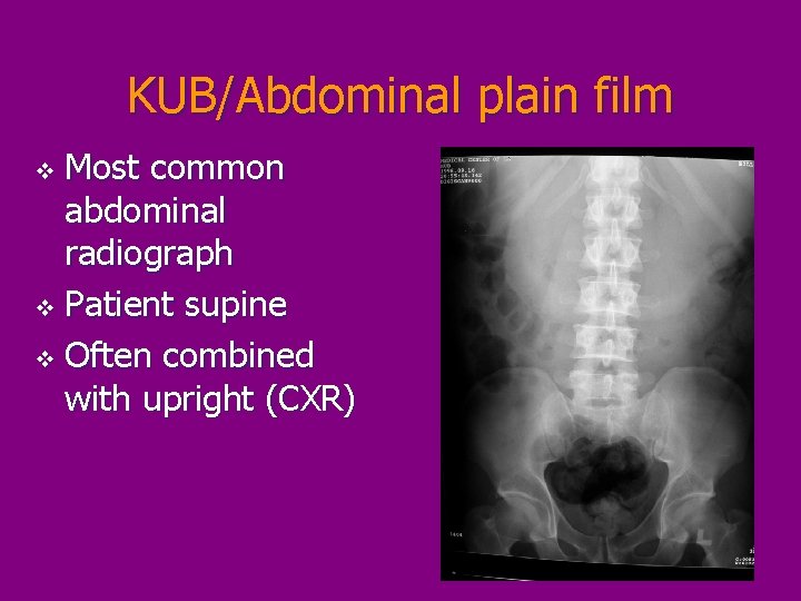KUB/Abdominal plain film Most common abdominal radiograph v Patient supine v Often combined with