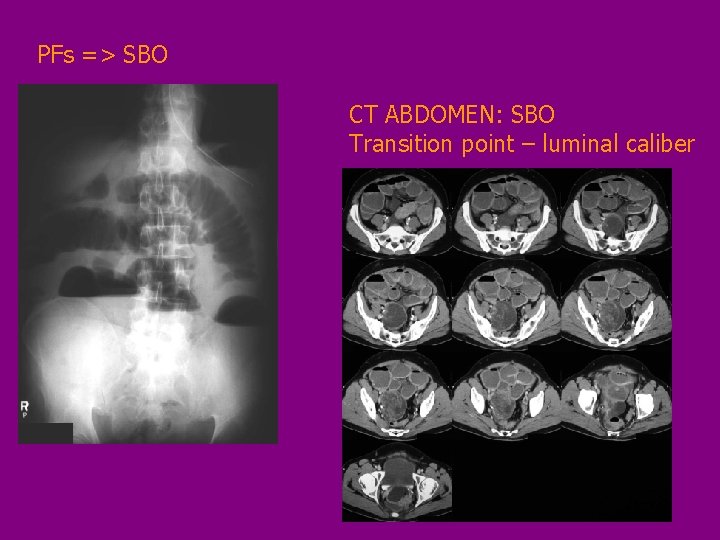 PFs => SBO CT ABDOMEN: SBO Transition point – luminal caliber 