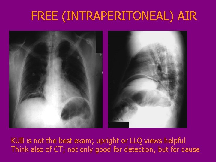 FREE (INTRAPERITONEAL) AIR KUB is not the best exam; upright or LLQ views helpful