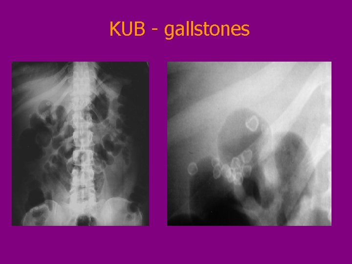 KUB - gallstones 