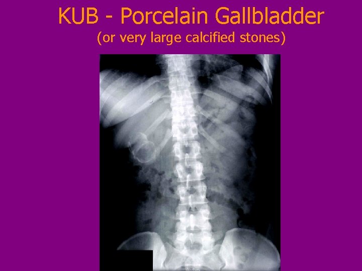 KUB - Porcelain Gallbladder (or very large calcified stones) 