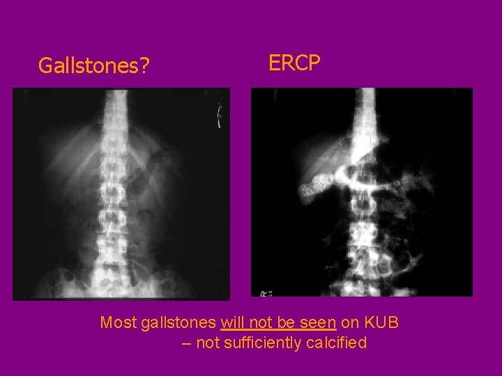 Gallstones? ERCP Most gallstones will not be seen on KUB – not sufficiently calcified