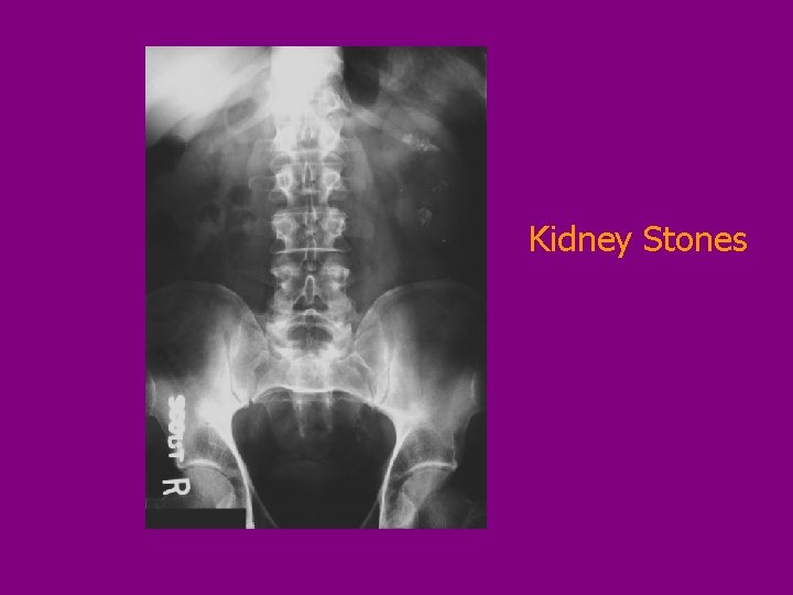 Kidney Stones 