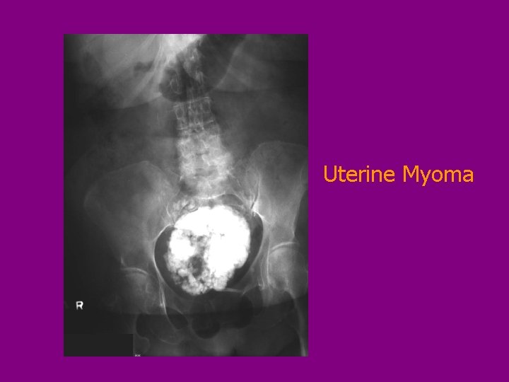 Uterine Myoma 