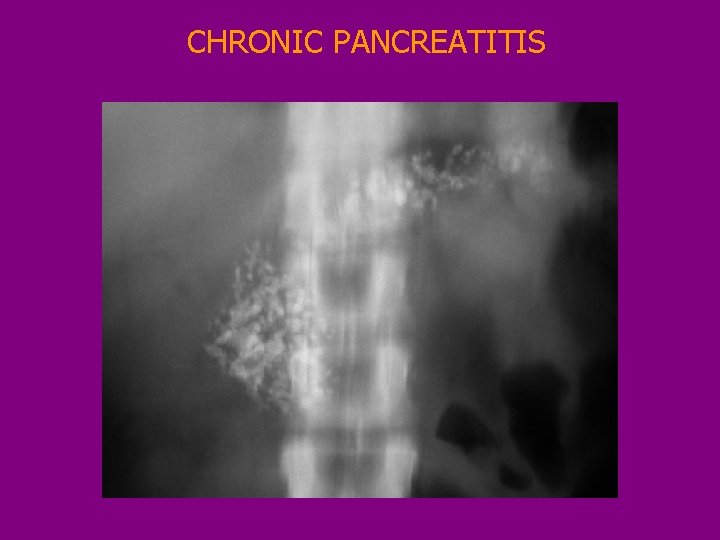 CHRONIC PANCREATITIS 