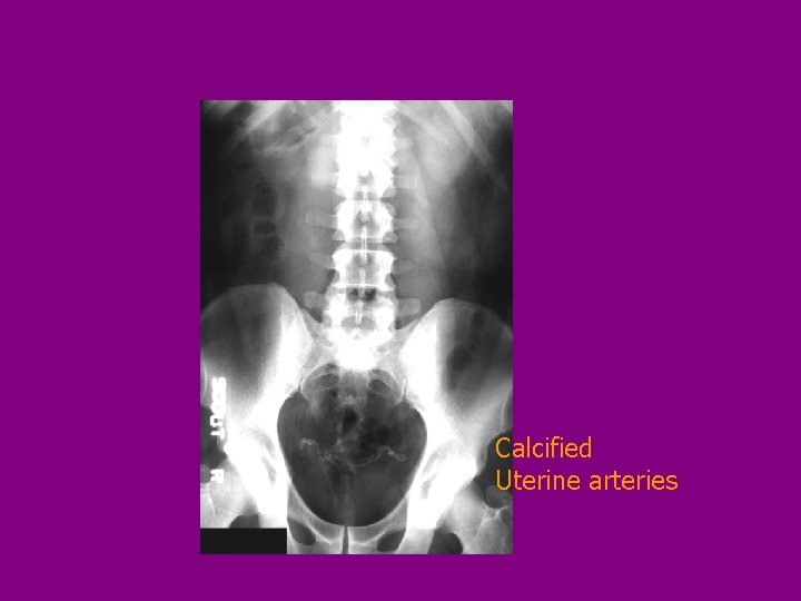 Calcified Uterine arteries 