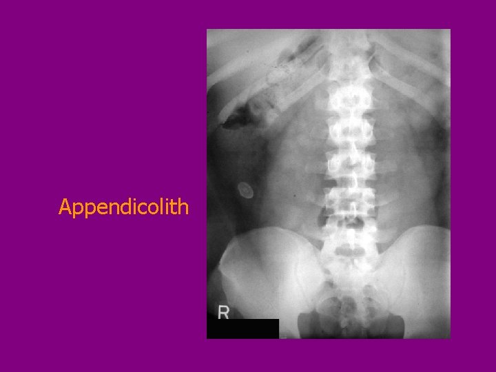 Appendicolith 