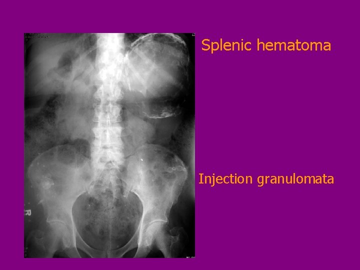 Splenic hematoma Injection granulomata 