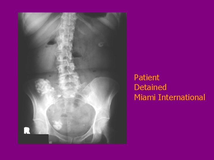 Patient Detained Miami International 