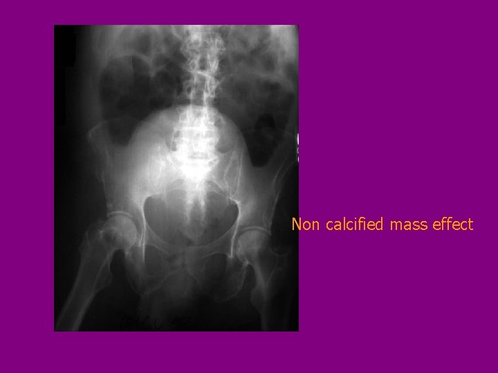 Non calcified mass effect 