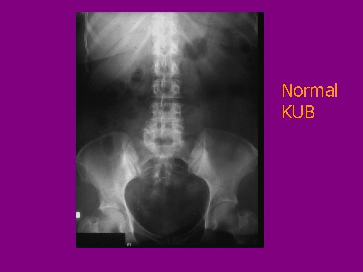 Normal KUB 