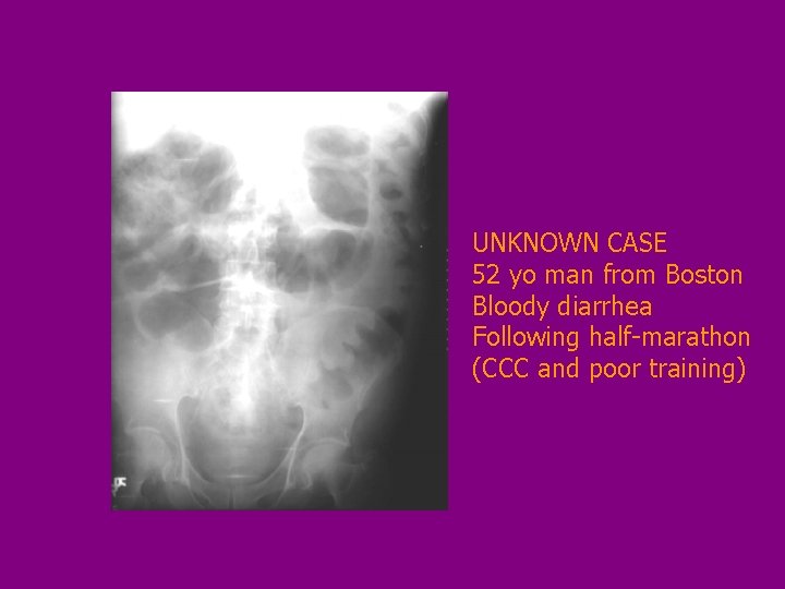 UNKNOWN CASE 52 yo man from Boston Bloody diarrhea Following half-marathon (CCC and poor