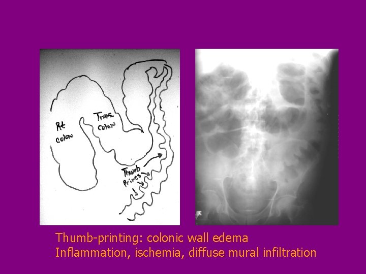 Thumb-printing: colonic wall edema Inflammation, ischemia, diffuse mural infiltration 