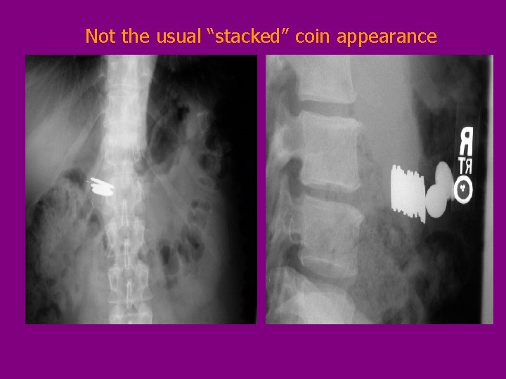 Not the usual “stacked” coin appearance 