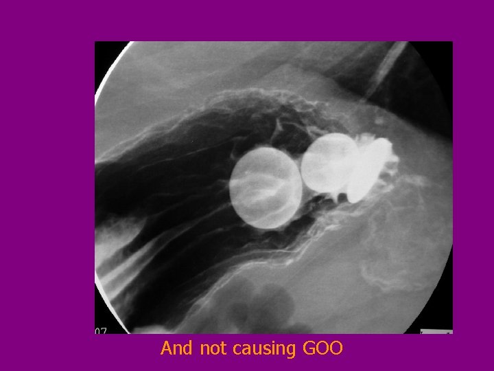And not causing GOO 