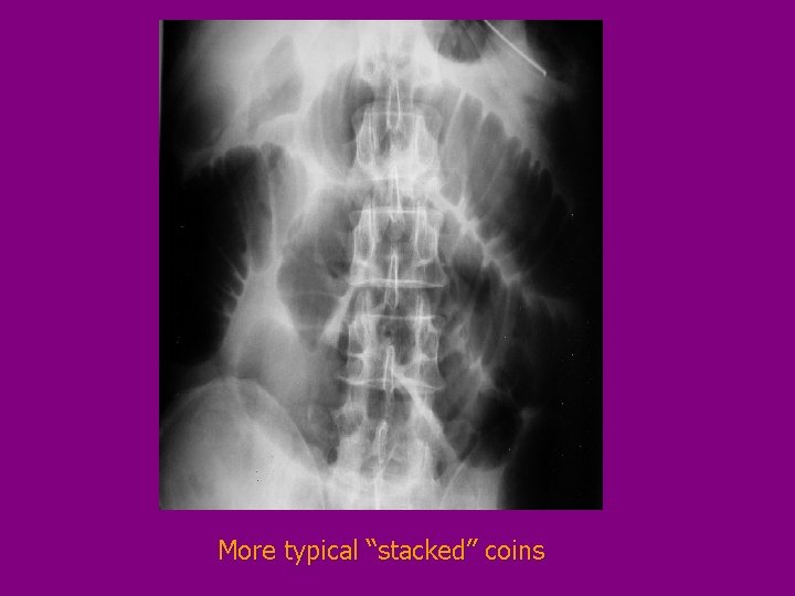 More typical “stacked” coins 