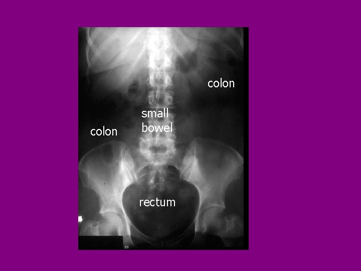colon small bowel rectum 