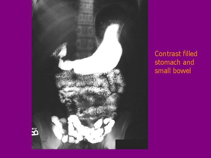 Contrast filled stomach and small bowel 