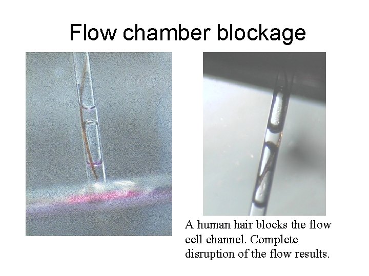 Flow chamber blockage A human hair blocks the flow cell channel. Complete disruption of