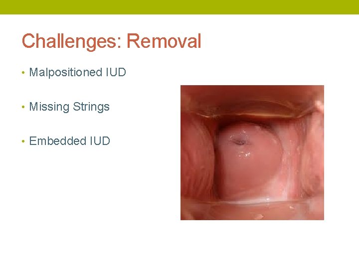 Challenges: Removal • Malpositioned IUD • Missing Strings • Embedded IUD 