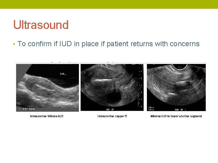 Ultrasound • To confirm if IUD in place if patient returns with concerns 