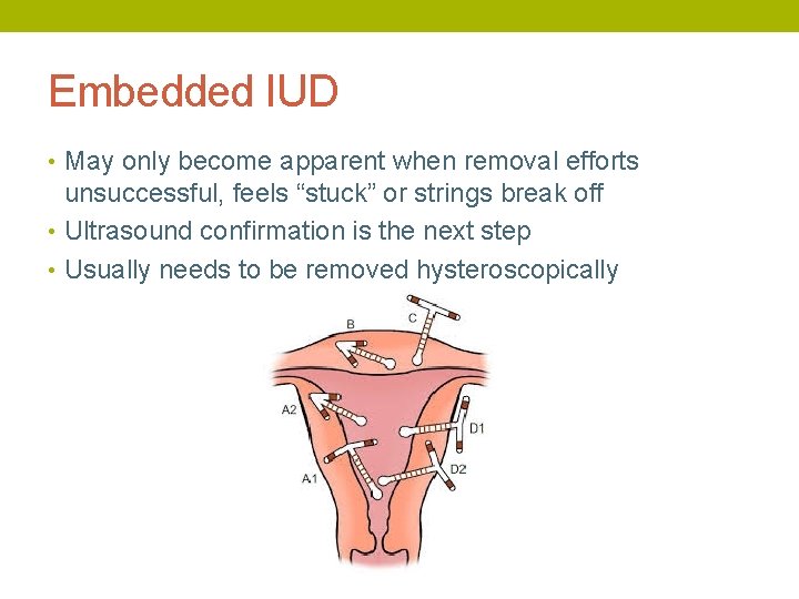 Embedded IUD • May only become apparent when removal efforts unsuccessful, feels “stuck” or