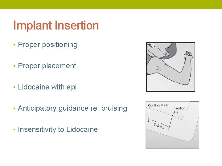 Implant Insertion • Proper positioning • Proper placement • Lidocaine with epi • Anticipatory