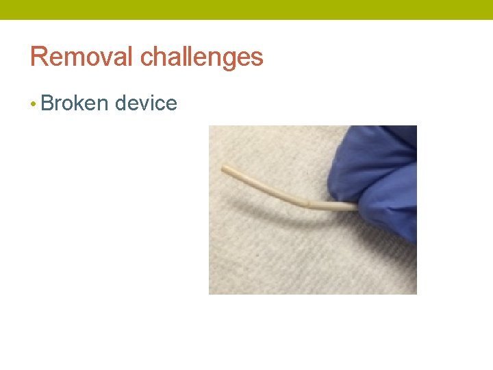 Removal challenges • Broken device 