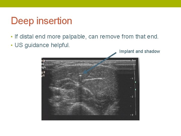 Deep insertion • If distal end more palpable, can remove from that end. •