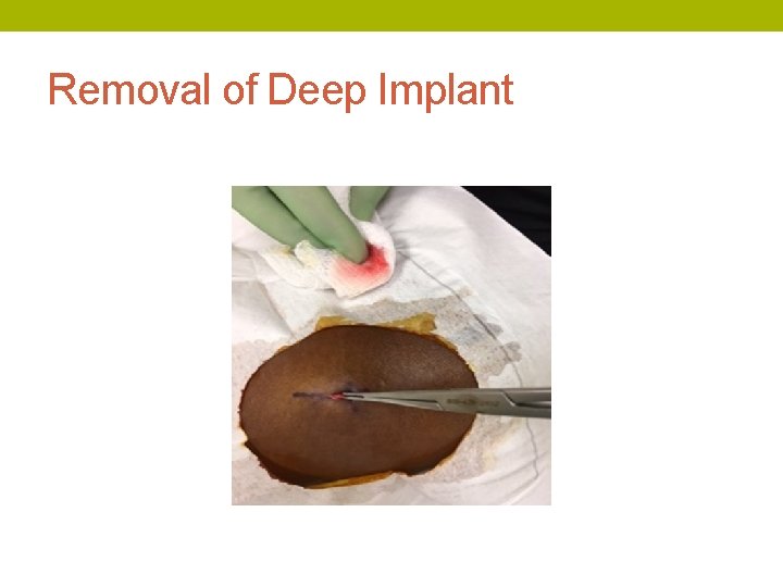 Removal of Deep Implant 