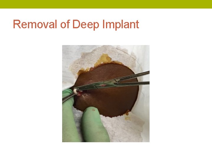 Removal of Deep Implant 