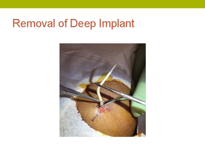 Removal of Deep Implant 