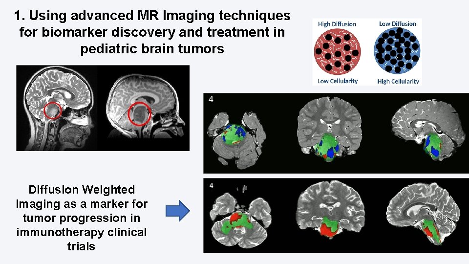 1. Using advanced MR Imaging techniques for biomarker discovery and treatment in pediatric brain 1. Using advanced MR Imaging techniques for biomarker discovery and treatment in pediatric brain