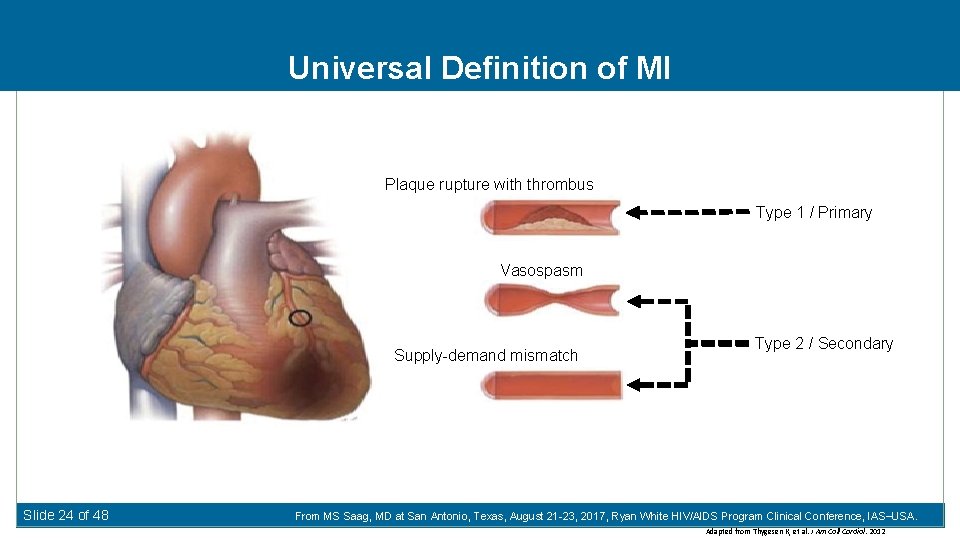 Universal Definition of MI Plaque rupture with thrombus Type 1 / Primary Vasospasm Supply-demand