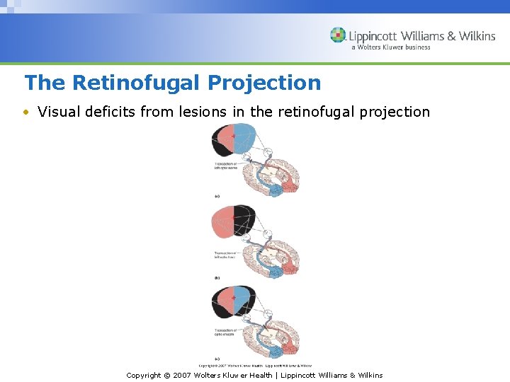 The Retinofugal Projection • Visual deficits from lesions in the retinofugal projection Copyright ©