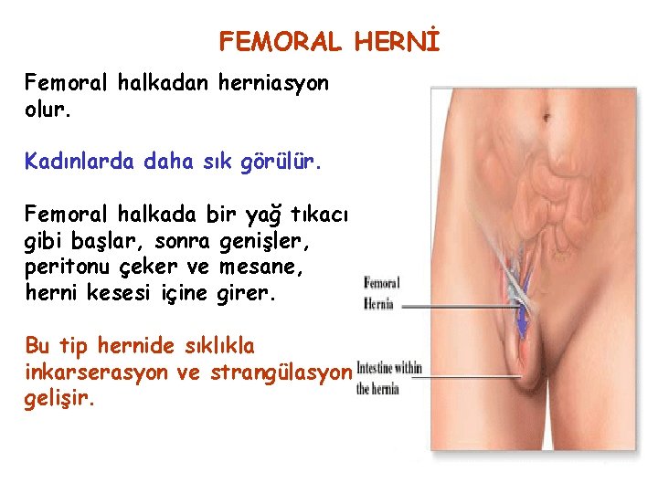 FEMORAL HERNİ Femoral halkadan herniasyon olur. Kadınlarda daha sık görülür. Femoral halkada bir yağ