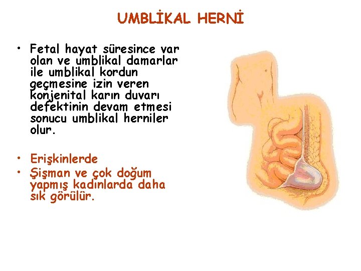 UMBLİKAL HERNİ • Fetal hayat süresince var olan ve umblikal damarlar ile umblikal kordun