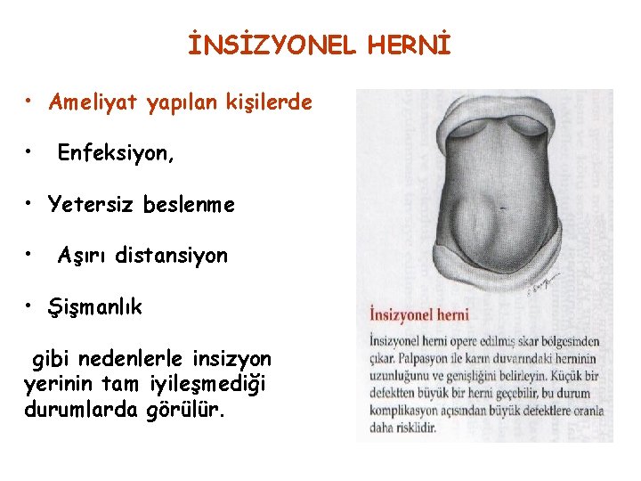 İNSİZYONEL HERNİ • Ameliyat yapılan kişilerde • Enfeksiyon, • Yetersiz beslenme • Aşırı distansiyon