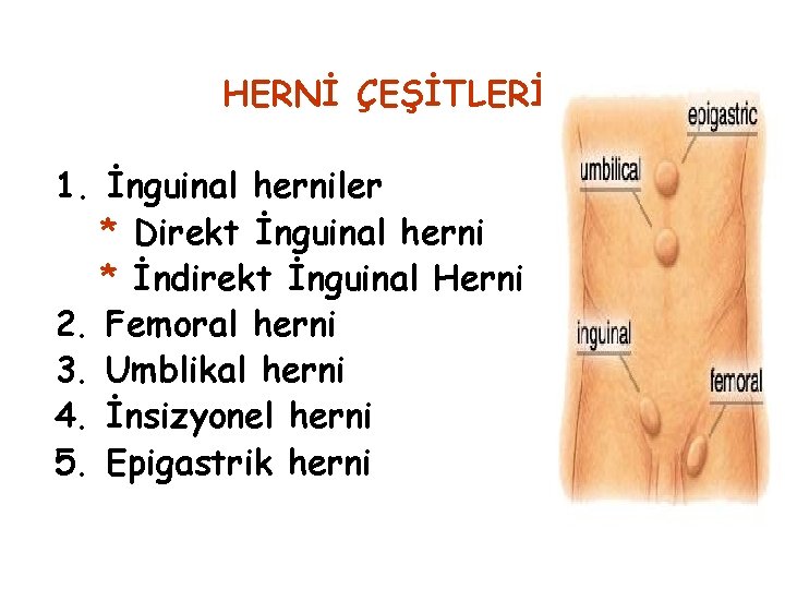 HERNİ ÇEŞİTLERİ 1. İnguinal herniler * Direkt İnguinal herni * İndirekt İnguinal Herni 2.