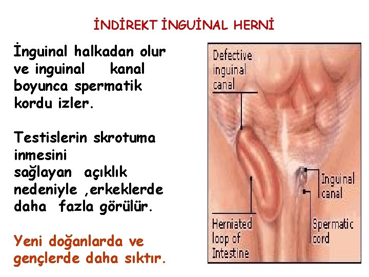 İNDİREKT İNGUİNAL HERNİ İnguinal halkadan olur ve inguinal kanal boyunca spermatik kordu izler. Testislerin