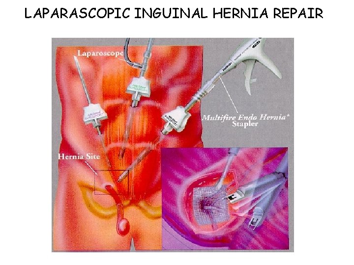 LAPARASCOPIC INGUINAL HERNIA REPAIR 