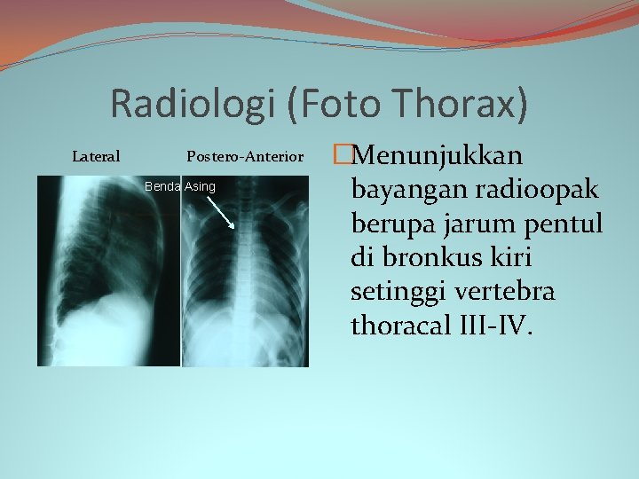 Radiologi (Foto Thorax) Lateral Postero-Anterior Benda Asing �Menunjukkan bayangan radioopak berupa jarum pentul di