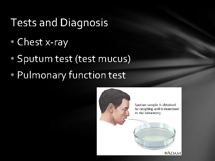 Tests and Diagnosis • Chest x-ray • Sputum test (test mucus) • Pulmonary function