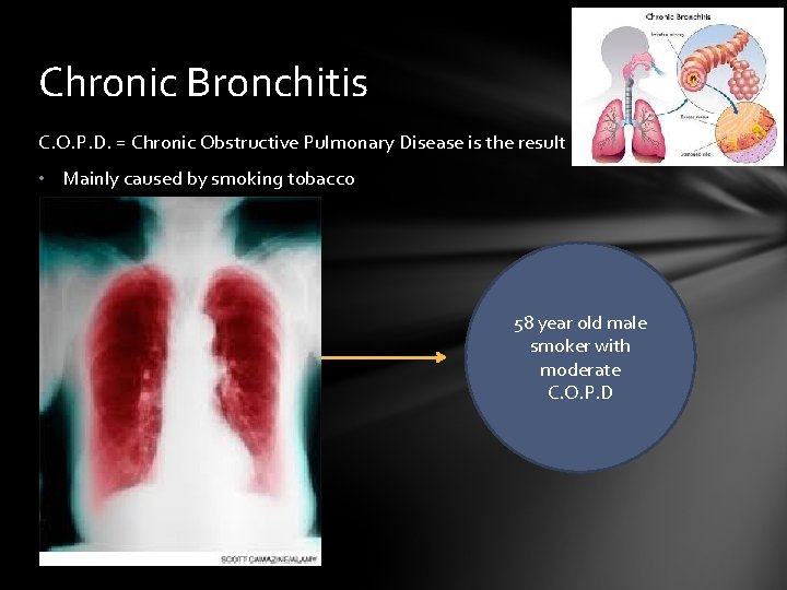 Chronic Bronchitis C. O. P. D. = Chronic Obstructive Pulmonary Disease is the result