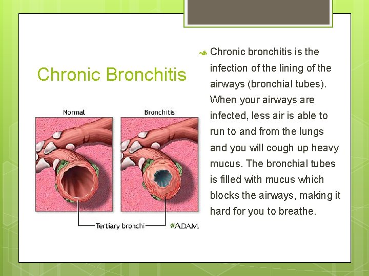  Chronic Bronchitis Chronic bronchitis is the infection of the lining of the airways